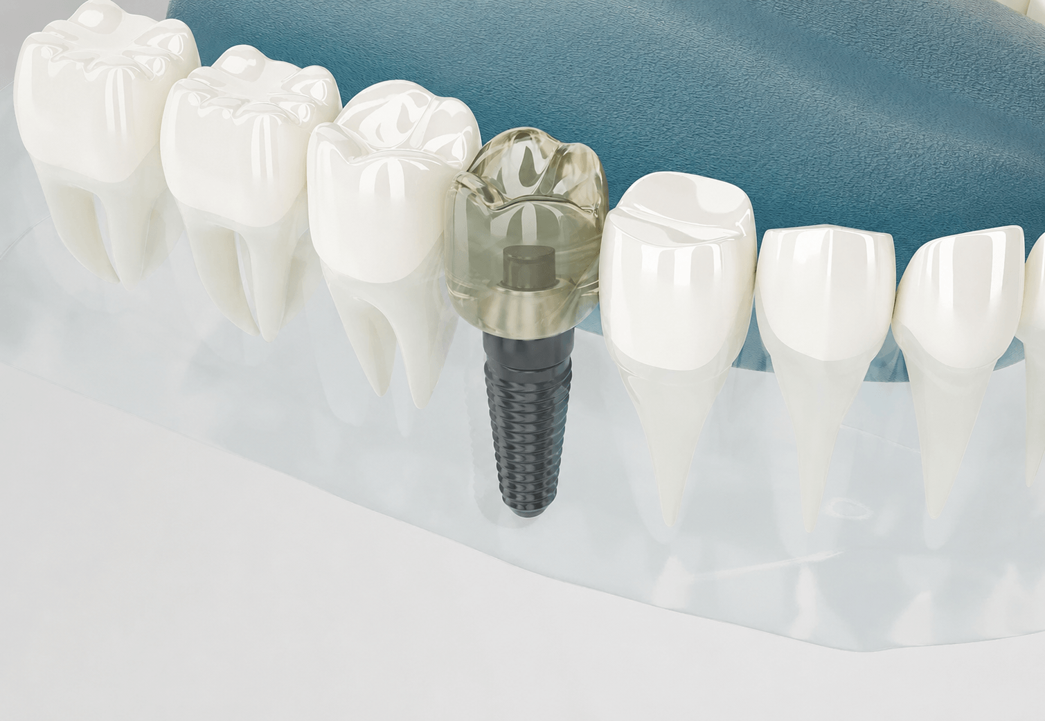 Dental implants